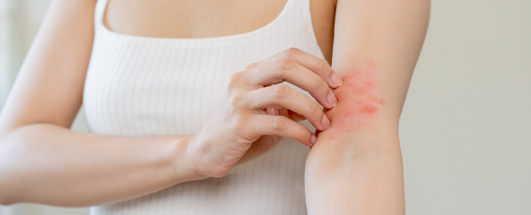 Mulher coçando o braço que apresenta manchas avermelhadas, como uma dermatite. 